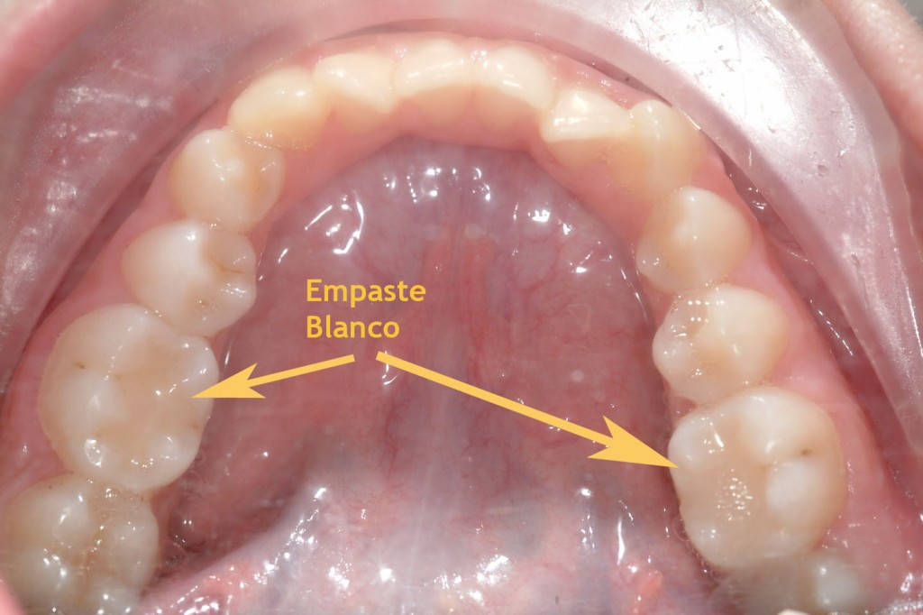 Empaste Blanco 1024x682