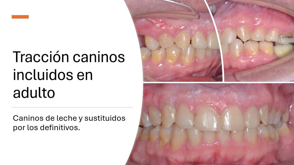 slide14