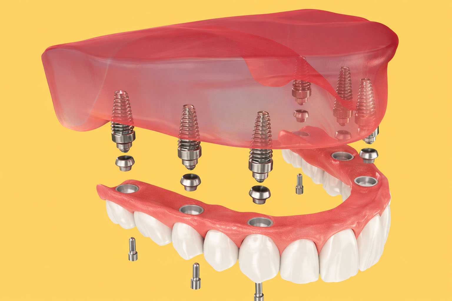 tratamiento prótesis dental1