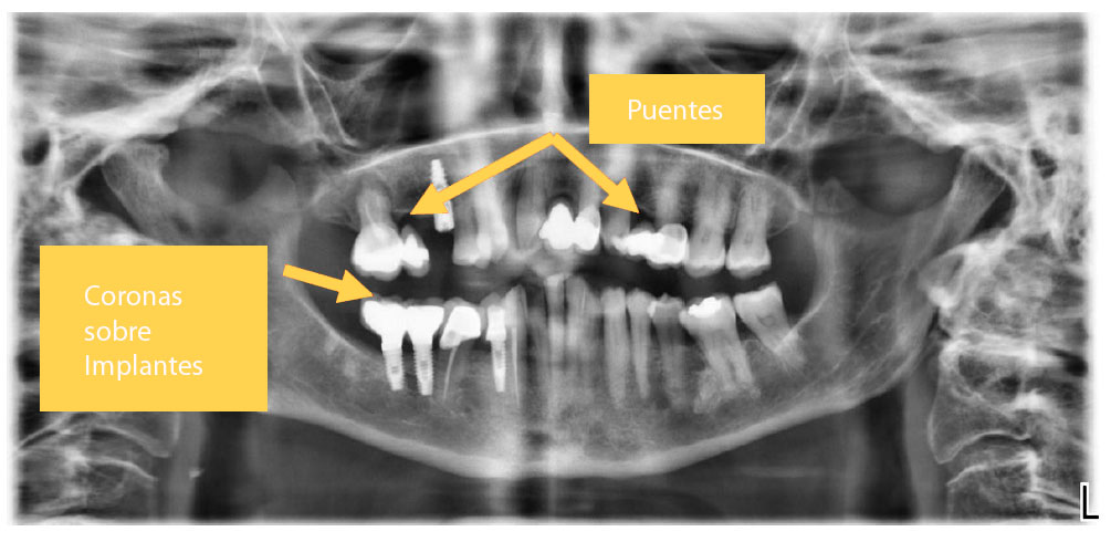 tratamiento prótesis1