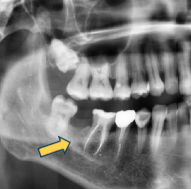 tratamiento endodoncia2