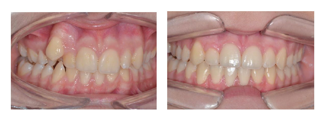 tratamiento ortodoncia1
