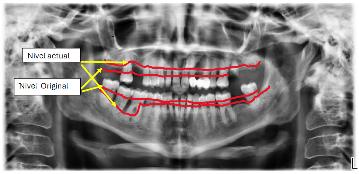 tratamiento periodoncia1